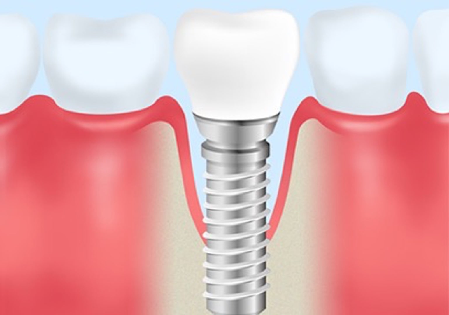 implant Q&A