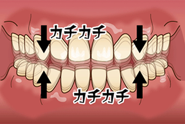 タッピング型