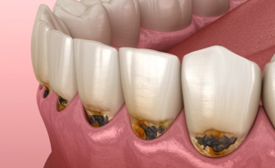 2.虫歯治療