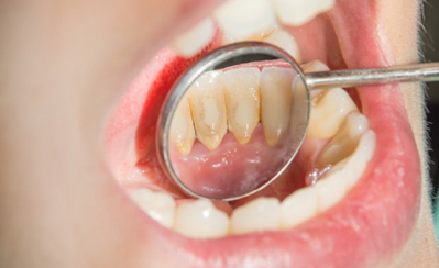 3.歯周病治療