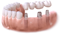 all on 4 implant